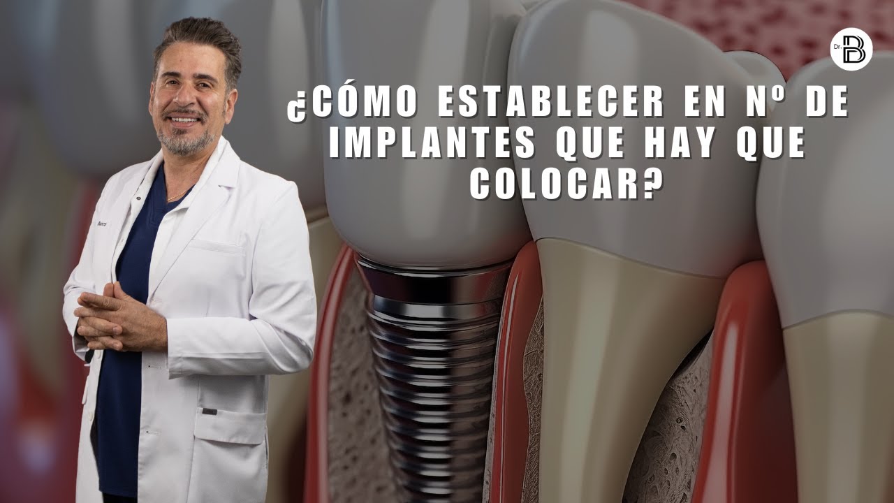 &iquest;C&oacute;mo sabe el Dr. Blanco en n&ordm; de implantes que coloca a cada paciente?👨&zwj;⚕️🦷
