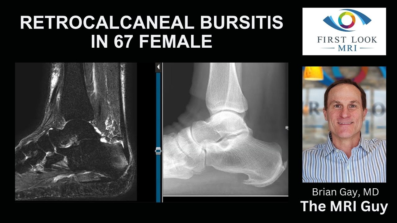 Heel pain from retrocalcaneal bursitis
