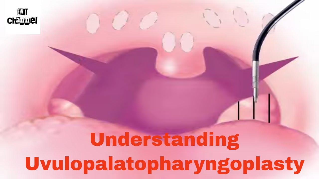 Animated Coblation assisted uvulopalatopharyngoplasty technique