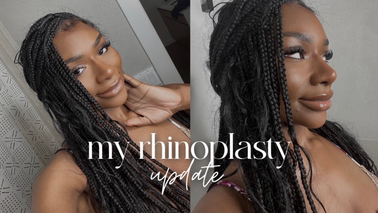 My 5 MONTH UPDATE | ETHNIC RHINOPLASTY TURKEY | ZIKA NNOLI