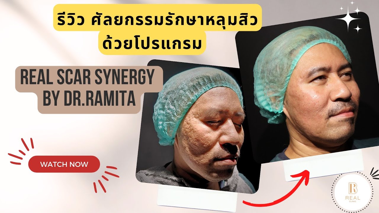 รีวิวโปรแกรม รักษาหลุมสิว Real Scar Synergy By Dr.Ramita