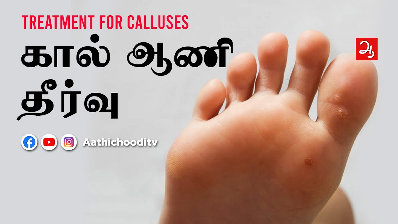 கால் ஆணி தீர்வு | Calluses treatment in Tamil homeopathy | Dr Vidhya | Aathichoodi