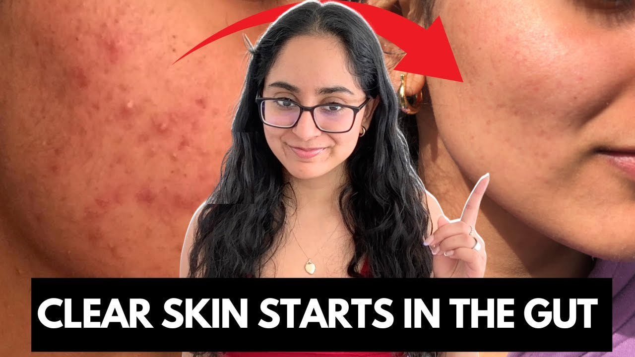Leaky Gut & Acne Explained: 2-Step Diet Fix for Hormones & Clear Skin