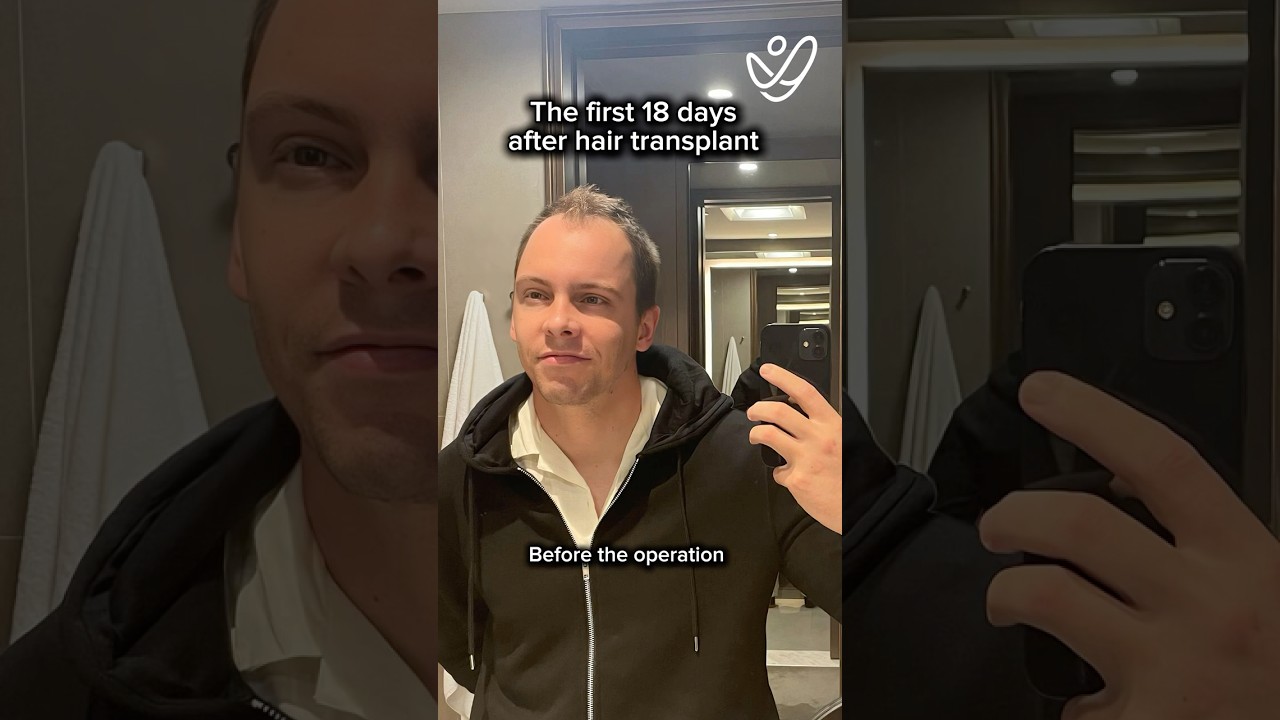 Hair Transplant Results: What Happens in the First 18 Days? (Shocking!)