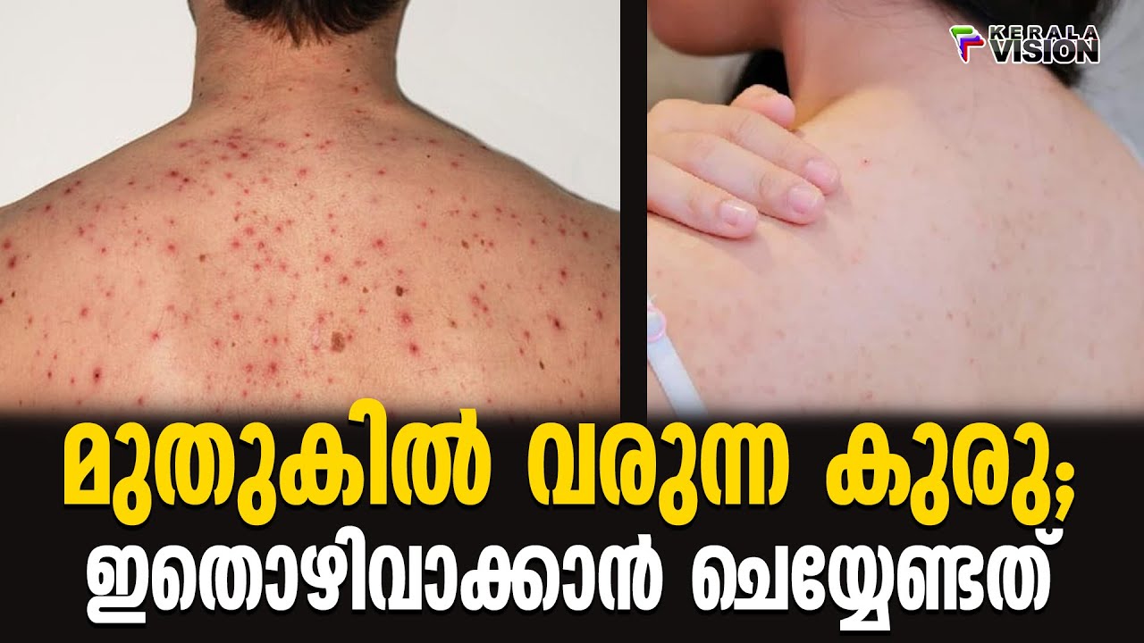 Abscess on the back; What to do to avoid this || Health Tips