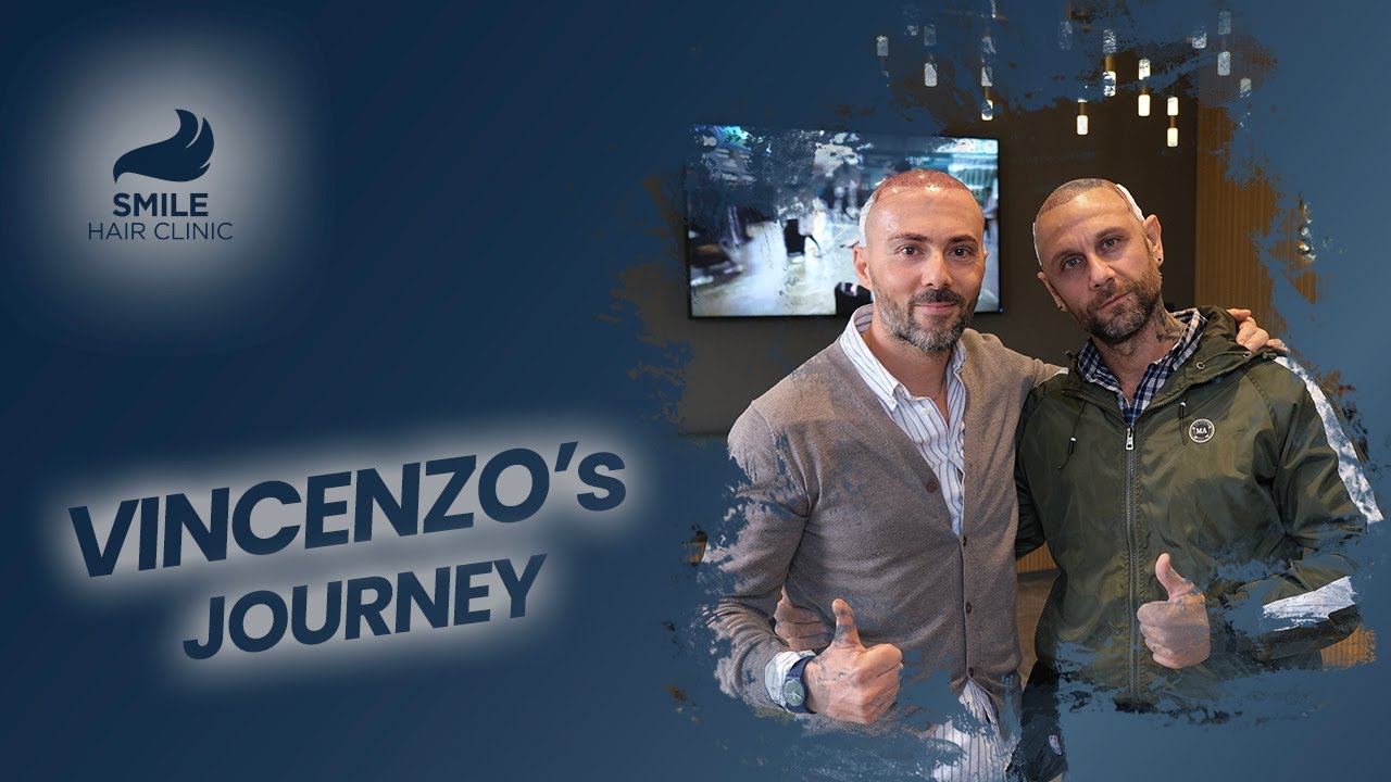 Two Vincenzos, One Journey: Italian Patients’ Hair Transplant Stories at Smile Hair Clinic
