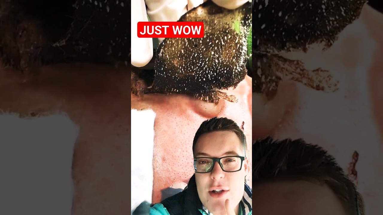 BEST PORE STRIP REMOVAL 2023 - Satisfying Blackhead Removal #shorts