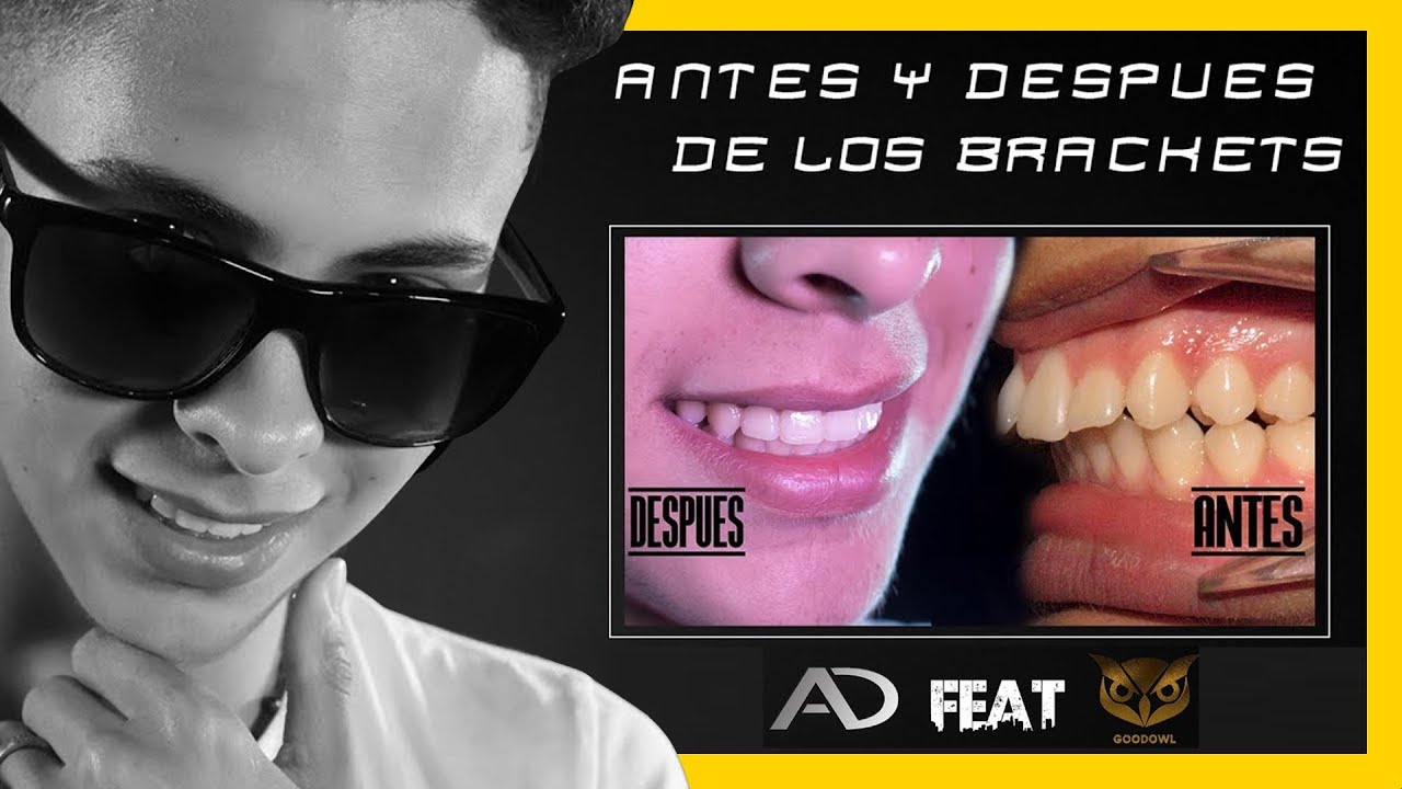 😎 ORTODONCIA CLASE II Antes y Despues CORREGIDA con BRACKETS METALICOS-Feat Goodowl