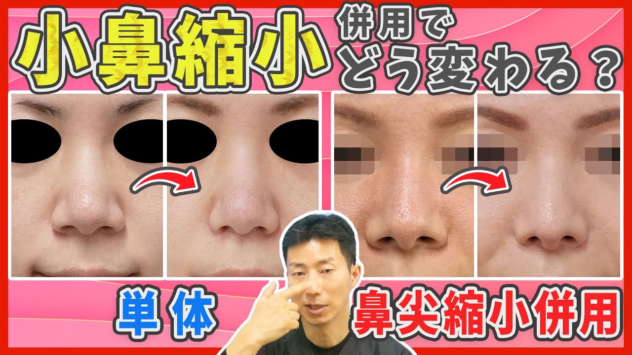 【鼻整形】理想の小鼻になるには、小鼻縮小と鼻尖縮小は併用すべきなのかを解説