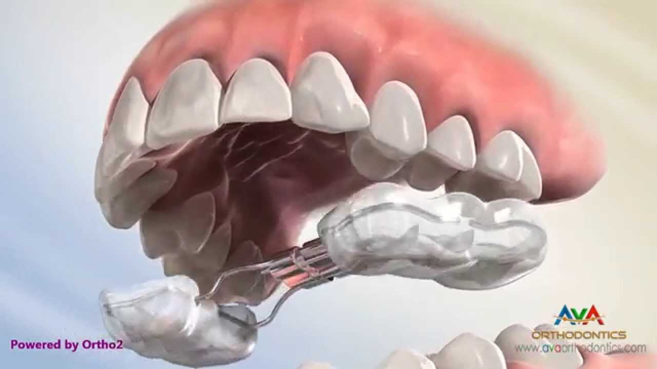Orthodontic Expander or Spacer - Bonded RPE Appliance
