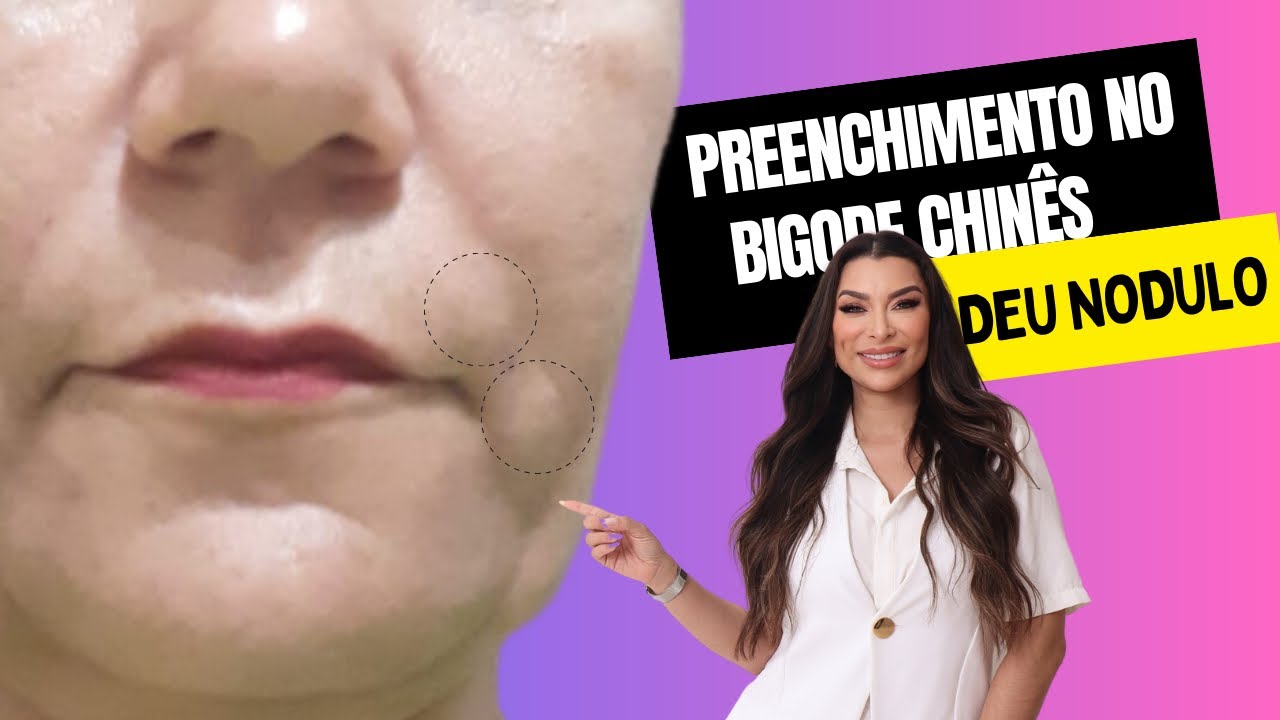 Fez Preenchimento e Surgiram Nódulos? Saiba o Motivo