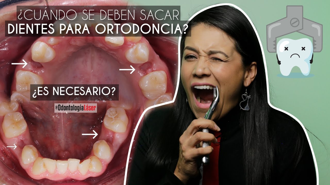 ¿Cuándo se deben sacar dientes para ortodoncia? ¿Es necesario? - Odontología Láser.