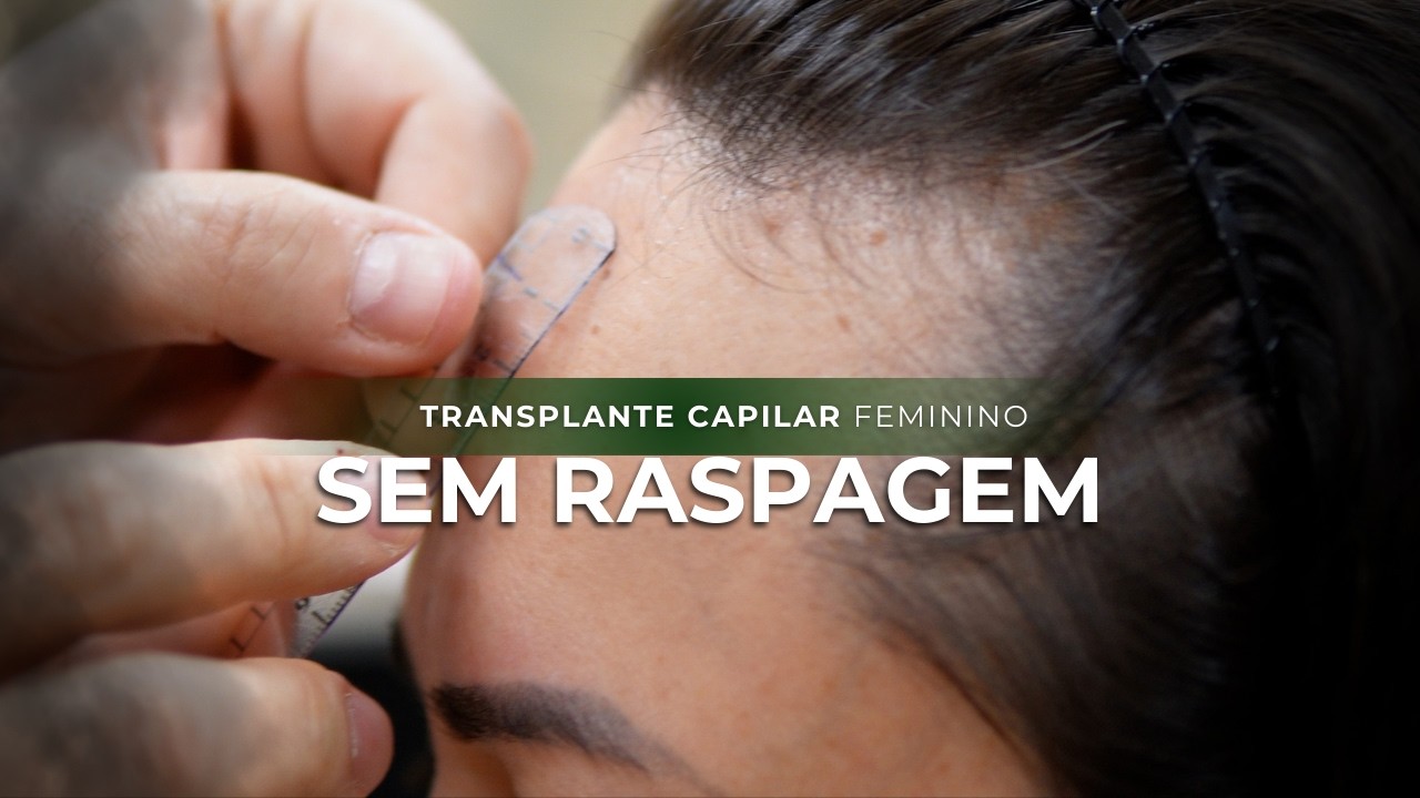 Transplante Capilar Feminino SEM RASPAR: Redução de Testa e Harmonização Facial