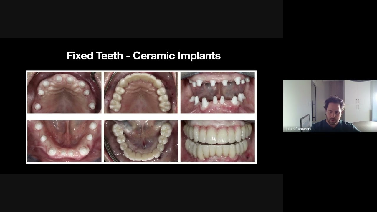 Full Arch Tooth Replacement - Know Your Options