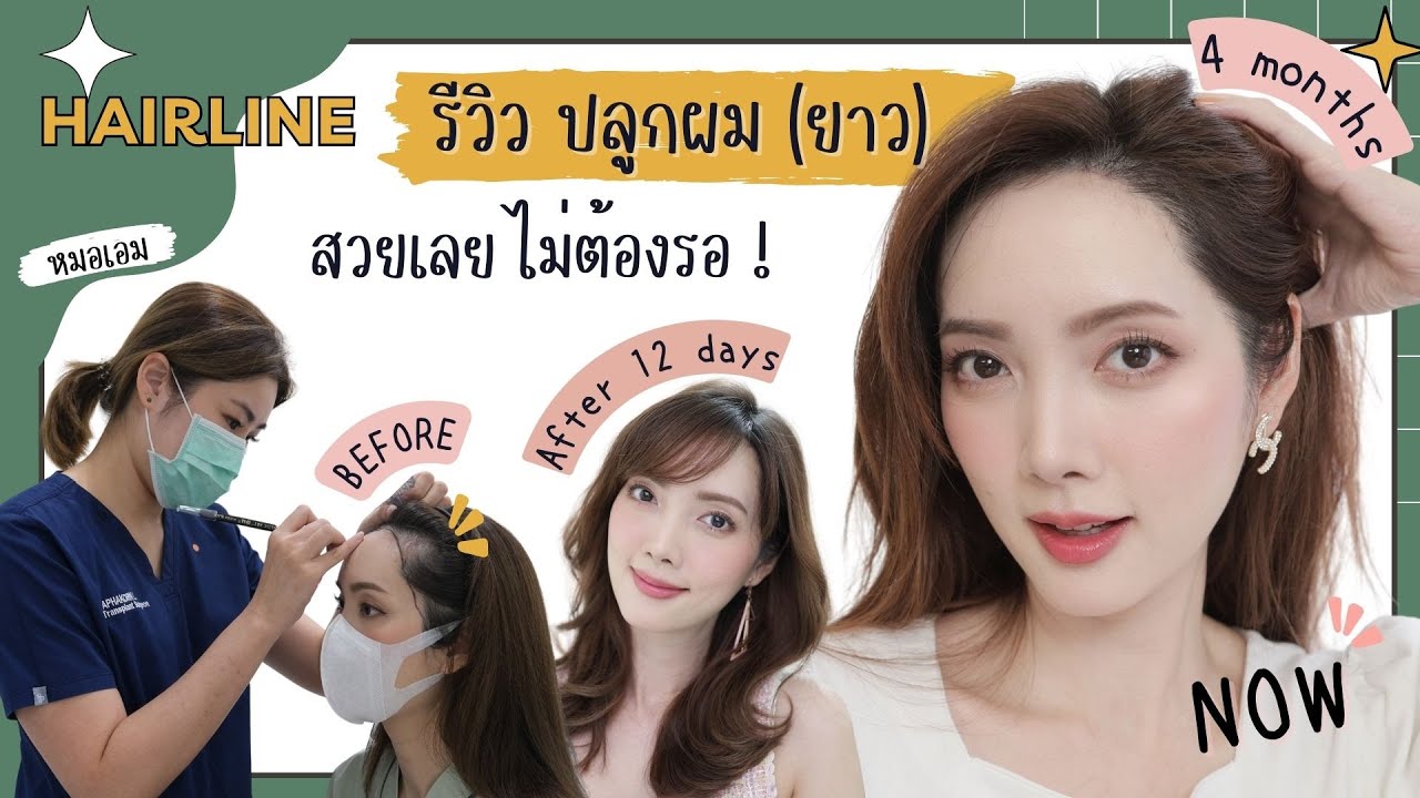 รีวิวปลูกผมยาว ทำเสร็จสวยเลย! (โนสปอน) ข้อมูลครบ จบในคลิปเดียว | Kirari TV