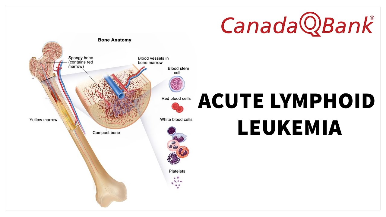 Acute Lymphoid Leukemia (ALL): Symptoms, Diagnosis & Treatment | High-Yield Hematology | CanadaQBank