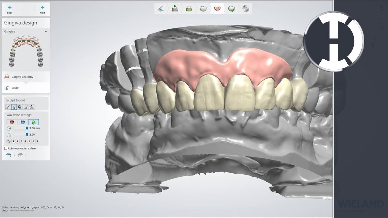 3Shape Study Club -  Design Challenge #1 -  DentalTechTips