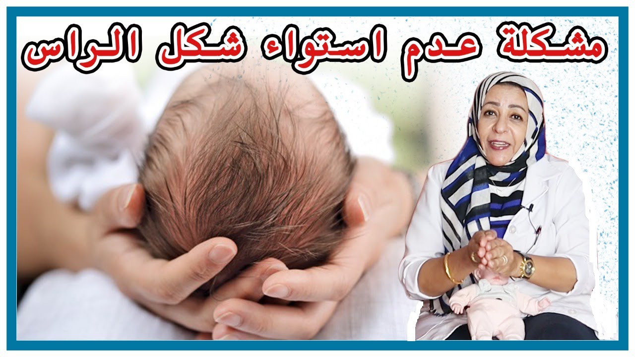 عدم_استدارة_شكل_رأس_المولود# 2021مشكلة عدم استواء شكل رأس الرضيع