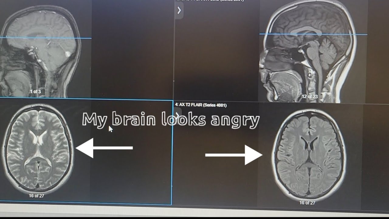 Brain health update | Another VLOG #196