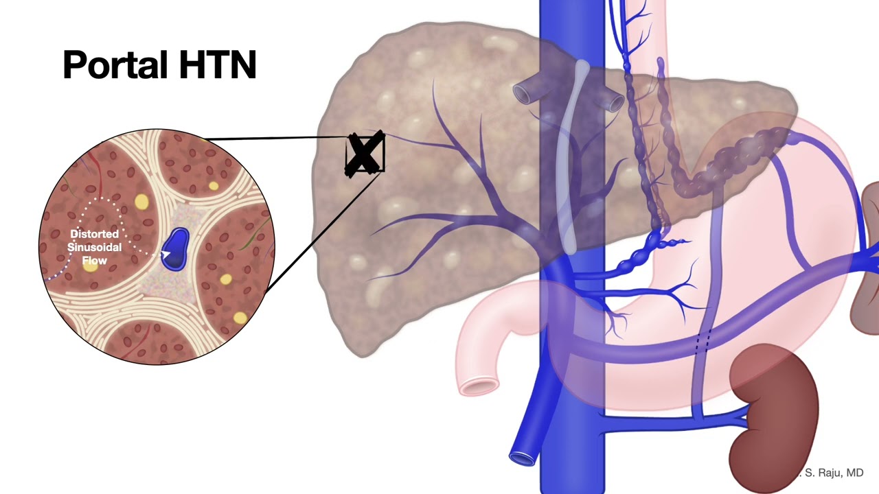 Esophagoscopy-Varices-Portal HTN Anatomy