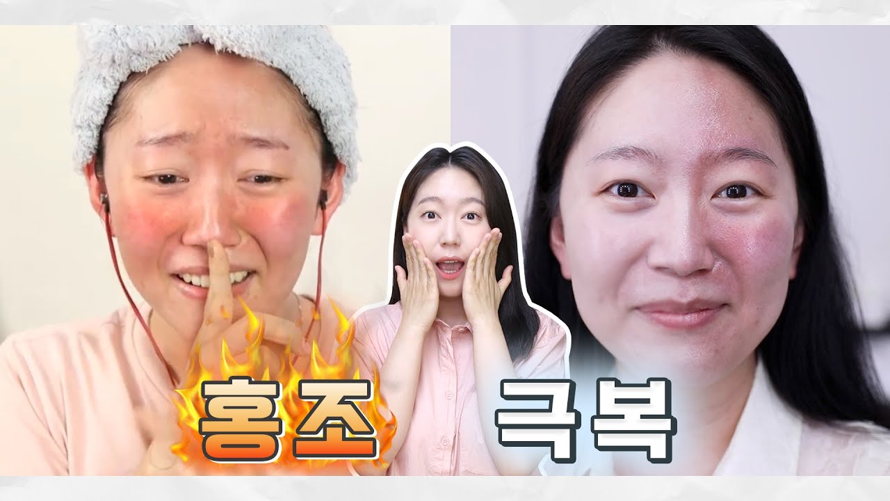 벌~건 홍조 왜 생김?! 홍조 낫는 방법은? 붉은기 가리는건 어찌해?! 찐 홍조인의 홍조 극복썰