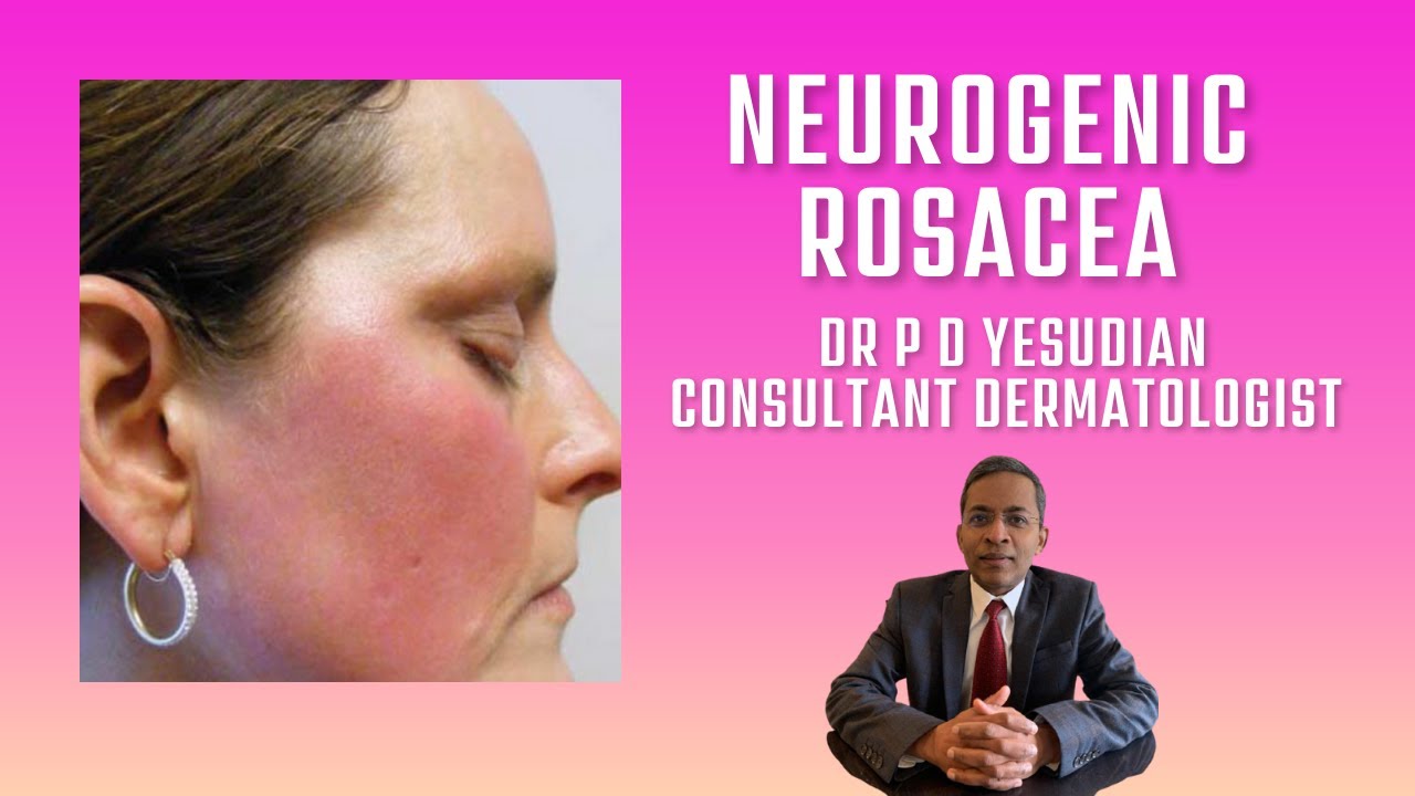 Neurogenic rosacea