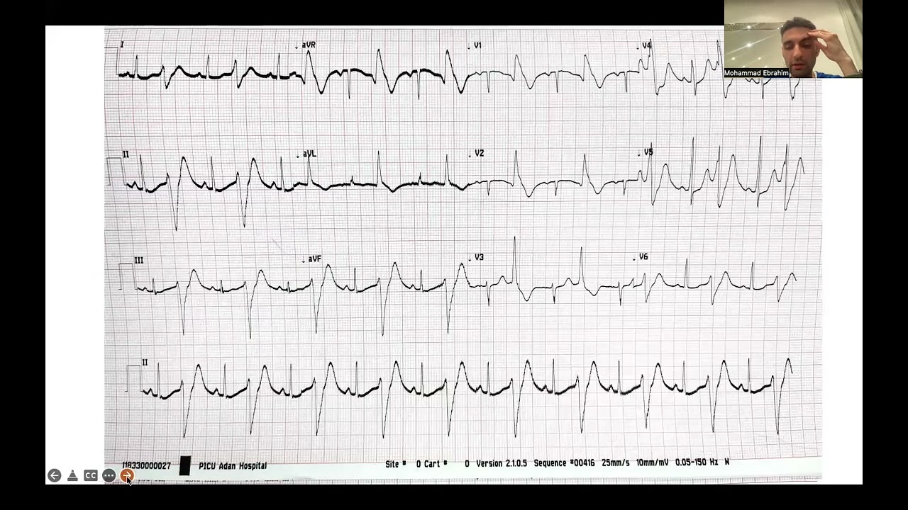 Overlap phenotype? (TECRL)