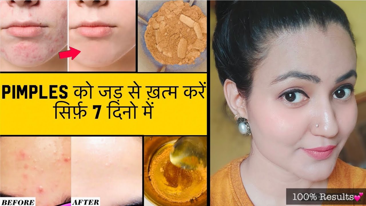In 7 Days 💕 PIMPLES को जड़ से खत्म करें सिर्फ 7 दिनों में और पाए बेदाग़ Spotless Glowing Skin 100%