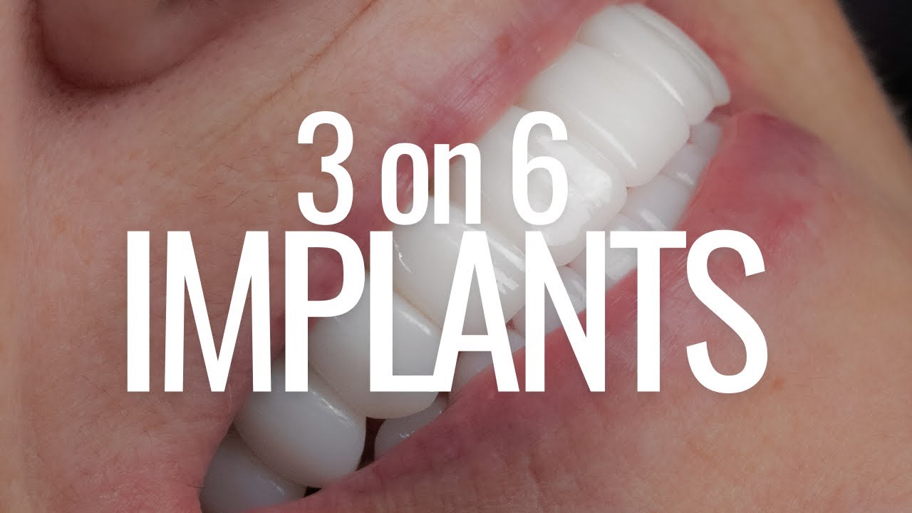 3 ON 6 Implants Chicago / 3 ON 6 Chicago / 3 on 6 Procedure