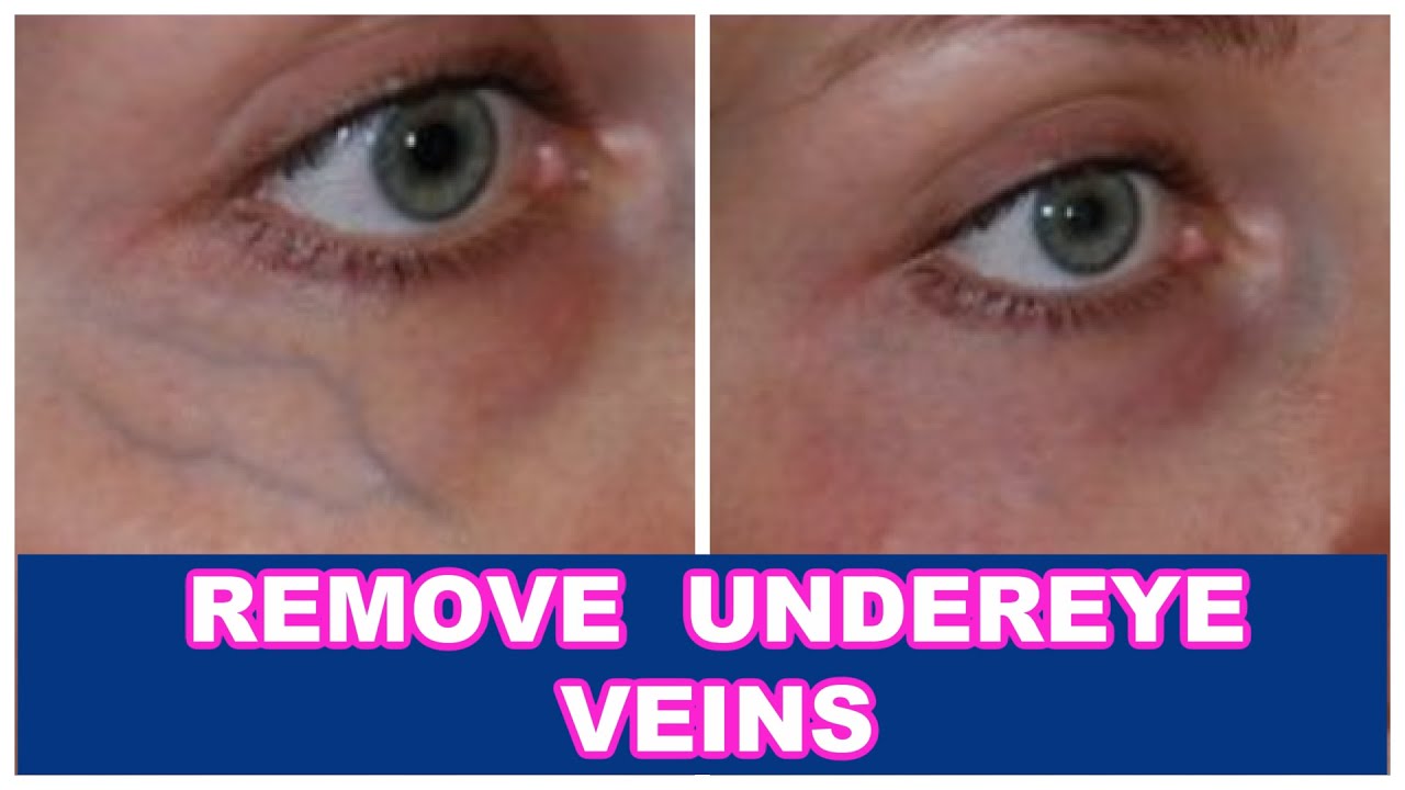 LASER TO REMOVE UNDEREYE VEINS