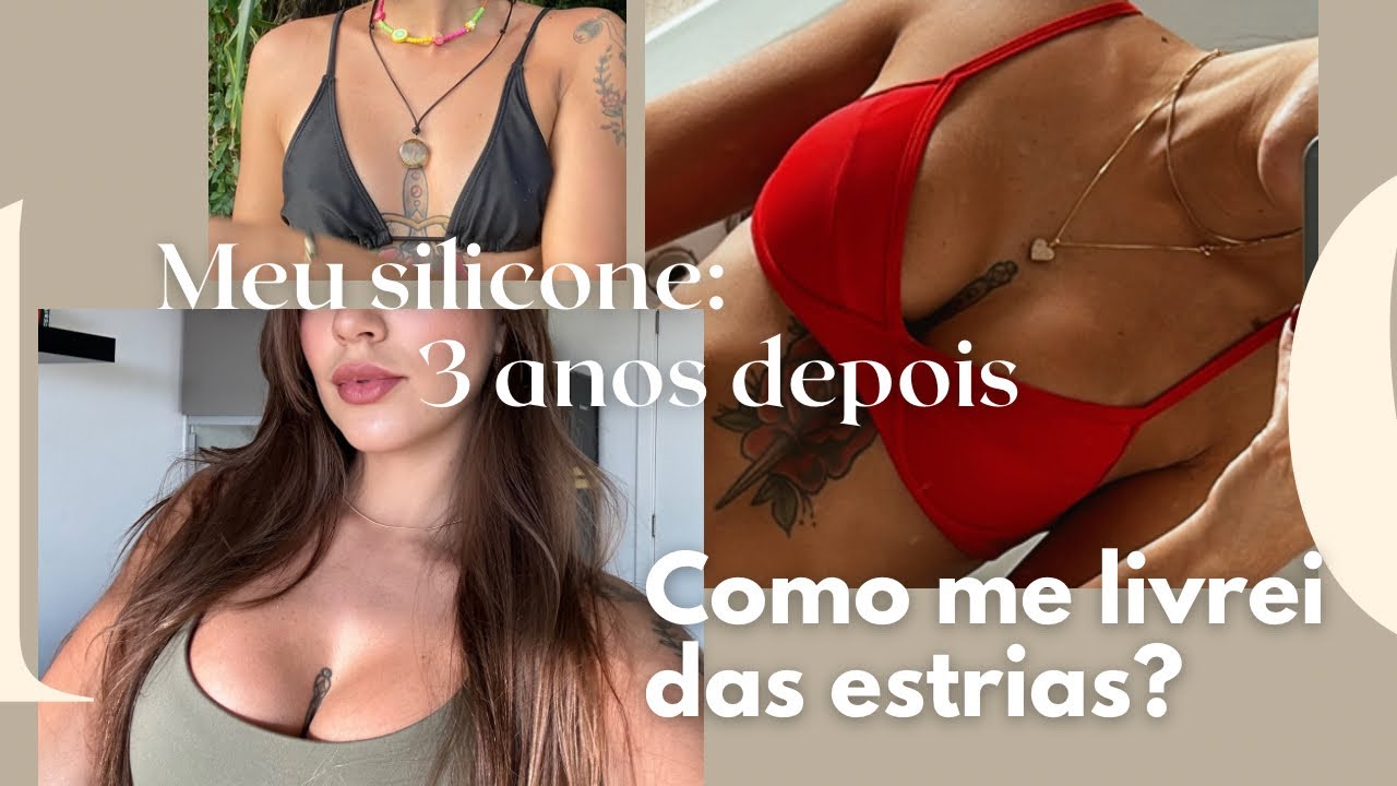 Meu silicone #5: 3 anos depois do silicone, como acabei com as estrias