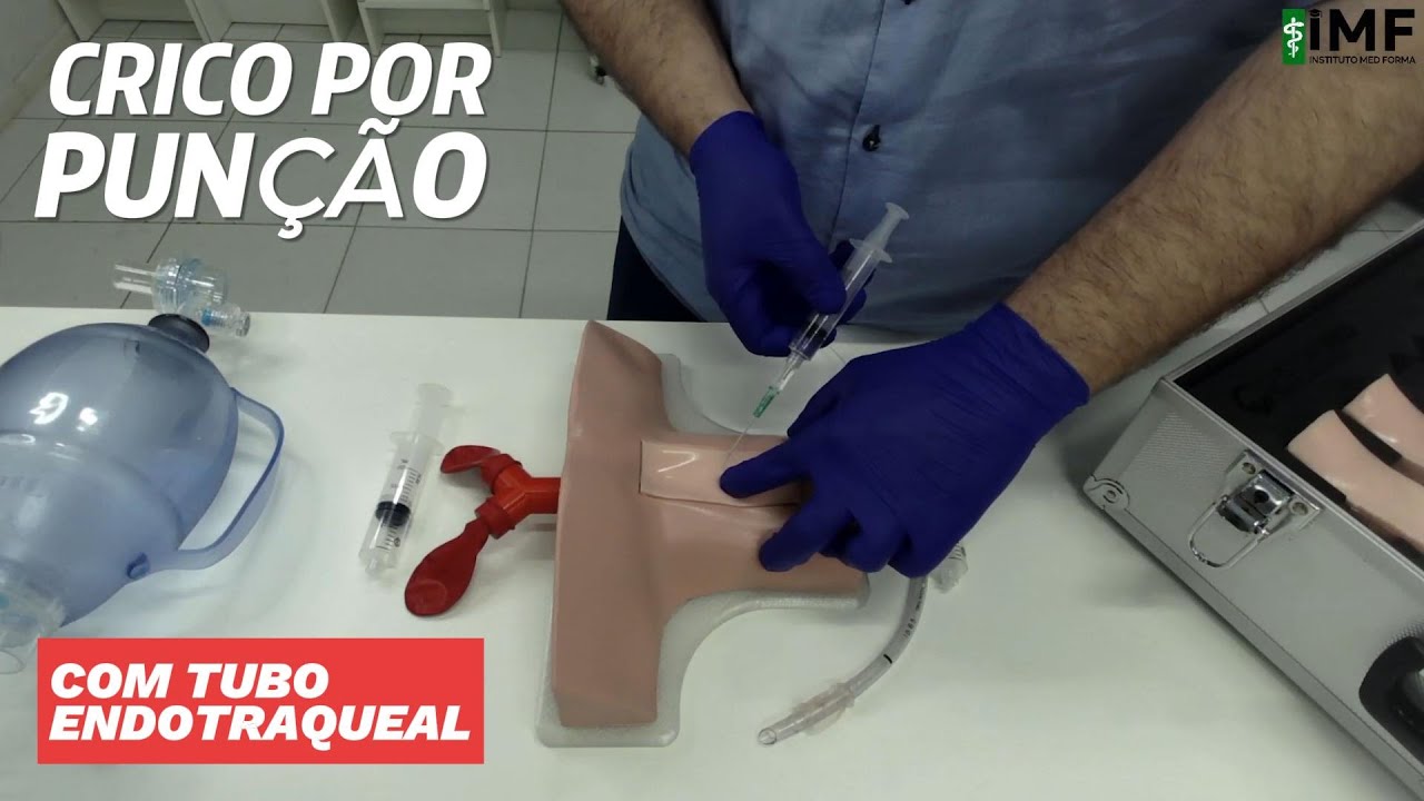 Cricotireidostomia por Pun&ccedil;&atilde;o - T&eacute;cnica com Tubo Endotraqueal