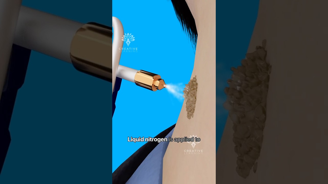 How Cryotherapy Removes Warts Safely #shorts #wartsremoval #viralvideo - Creativelearning3d