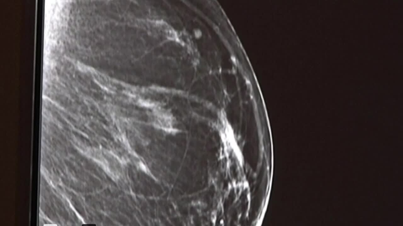 Your Healthy Family: Breast calcifications and DCIS