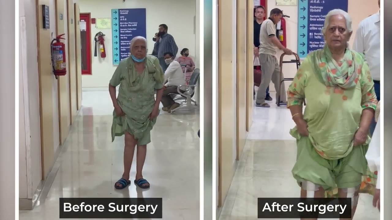 Patient with Knee Problem Sharing Her Experience After a Successful Total Knee Replacement Surgery