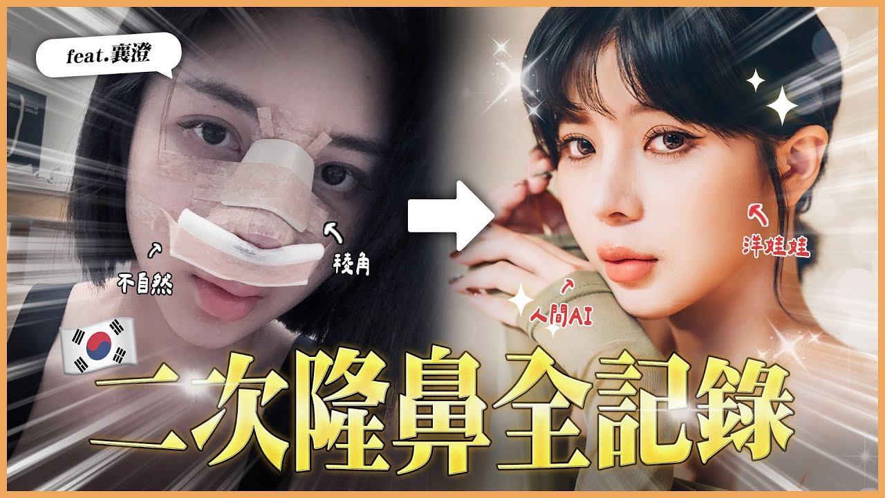🇰🇷 韓國隆鼻重修救上岸！襄澄終於滿意的超自然美感設計｜術前術後公開｜素人改造企劃S2｜feat.襄澄 莎莎韓很大 Shalisa  #莎莎韓很大 #韓國整形 #韓國醫美 #隆鼻
