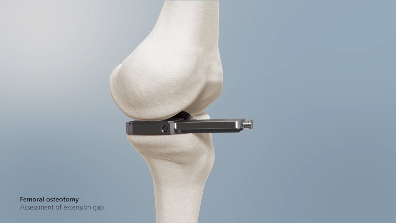 Mathys: balanSys UNI Surgical technique – Spacer Block
