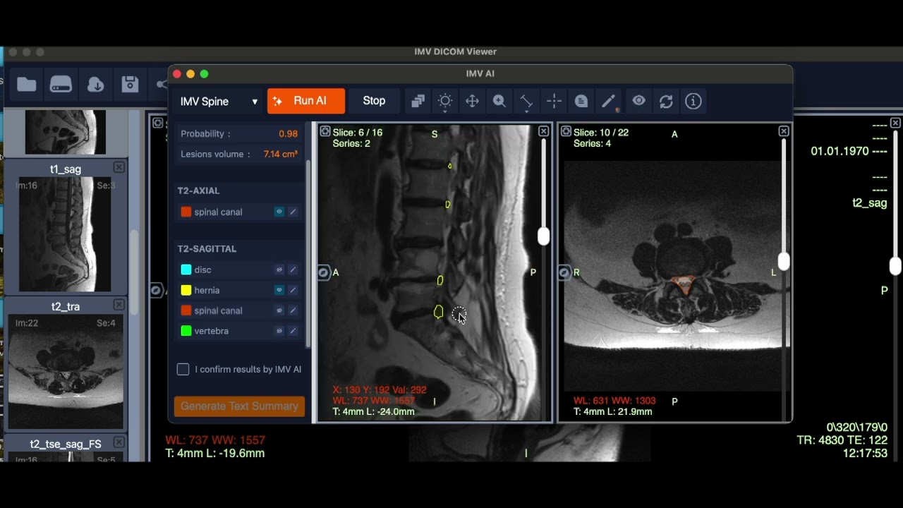 Revolutionary AI for Spine Analysis | IMV Spine