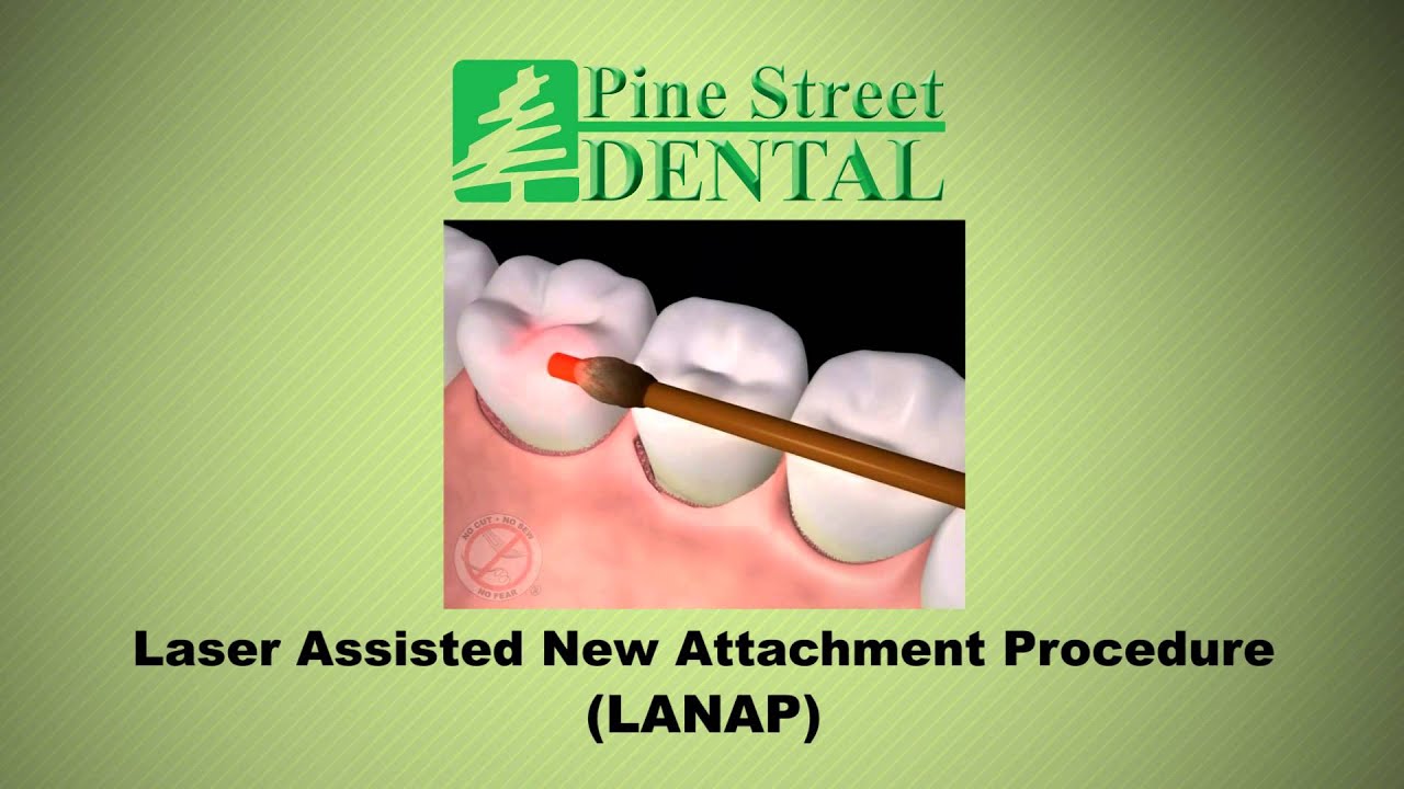 Laser Assisted New Attachment Procedure (LANAP)