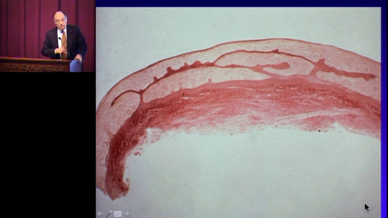 Epithelial Basement Membrane Dystrophy