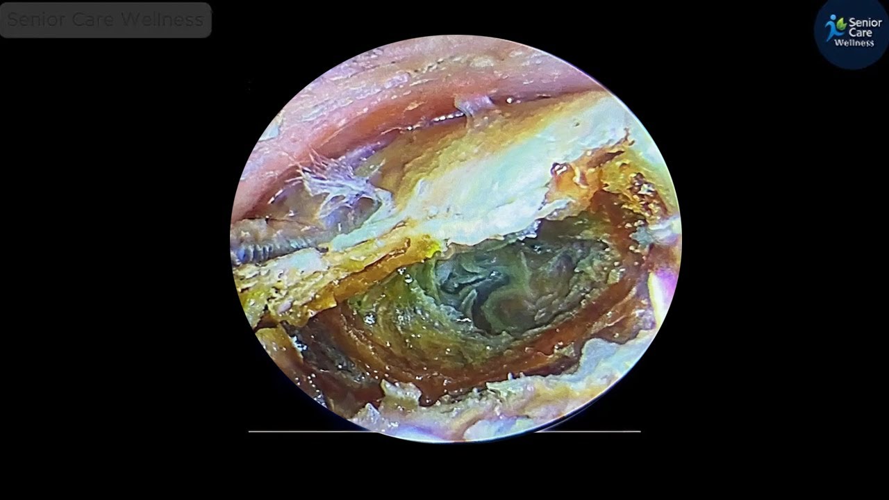 Hardest Earwax Ever &ndash; Senior Earwax Stuck Close to the Eardrum (ASMR)