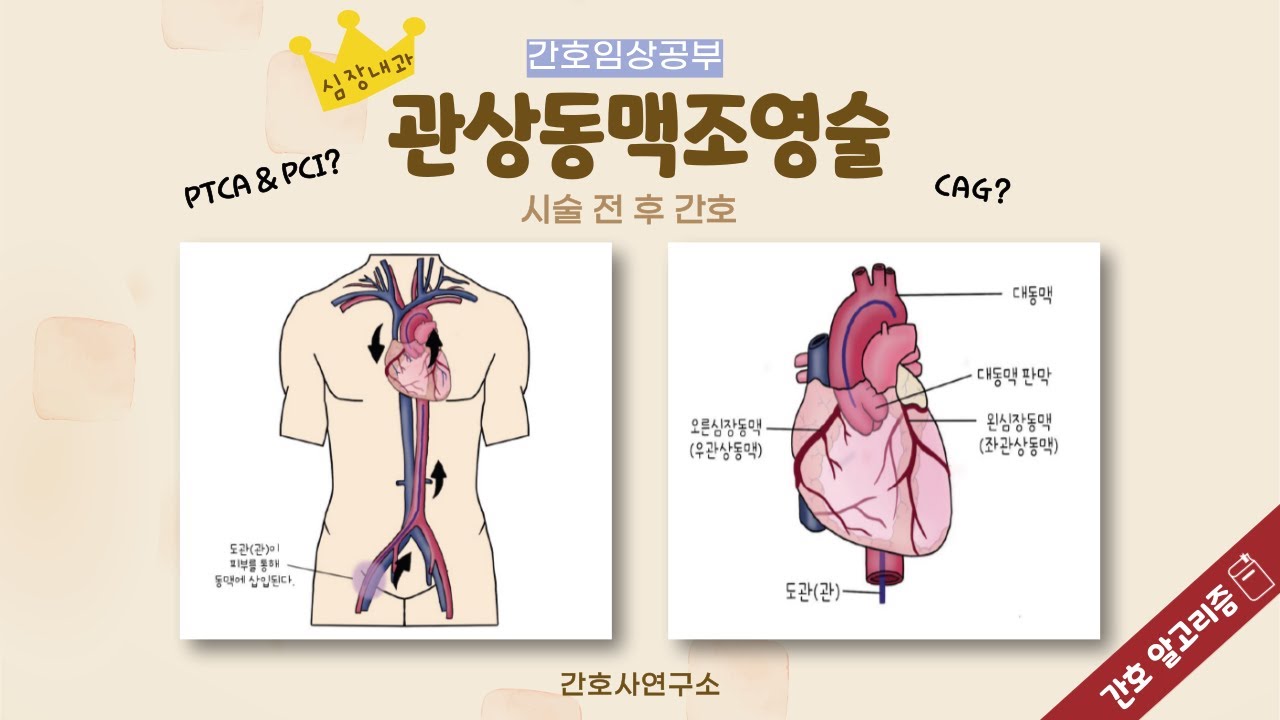 [간호임상공부]CAG, PCI, PTCA 시술 전 후 간호는 어떻게 할까요? | 관상동맥조영술
