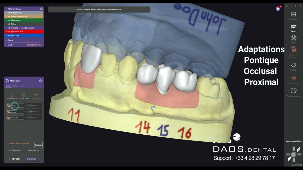 Exocad Rijeka 3.1 Stock Abutment - Daos Dental
