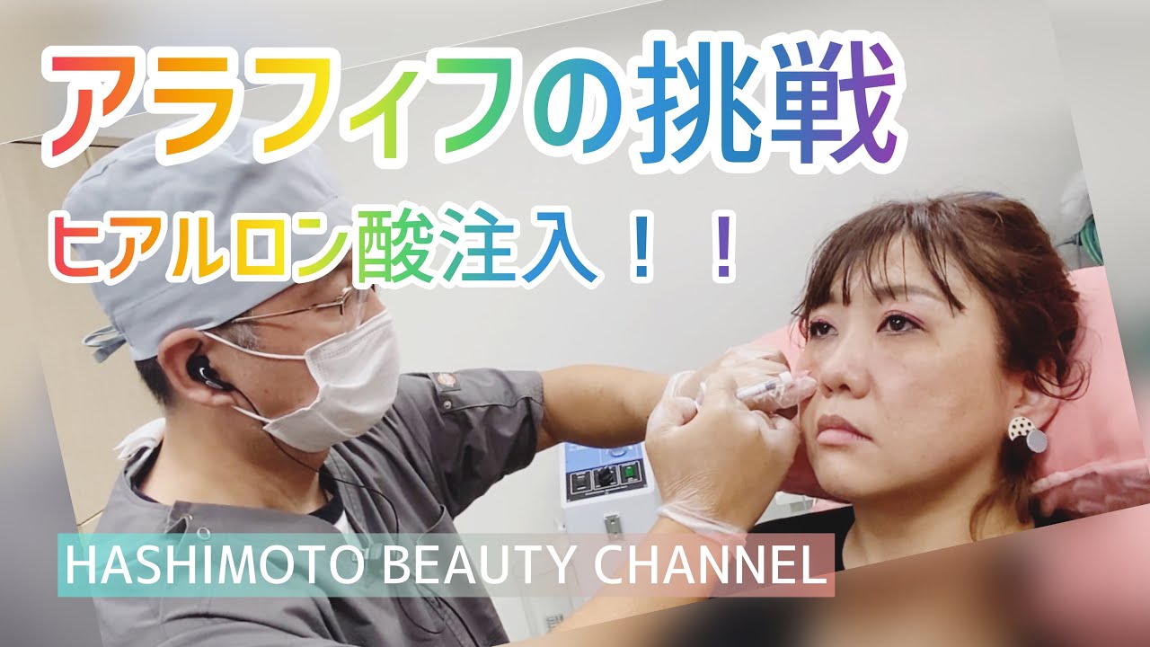 ゴルゴ線にヒアルロン酸注入した結果…