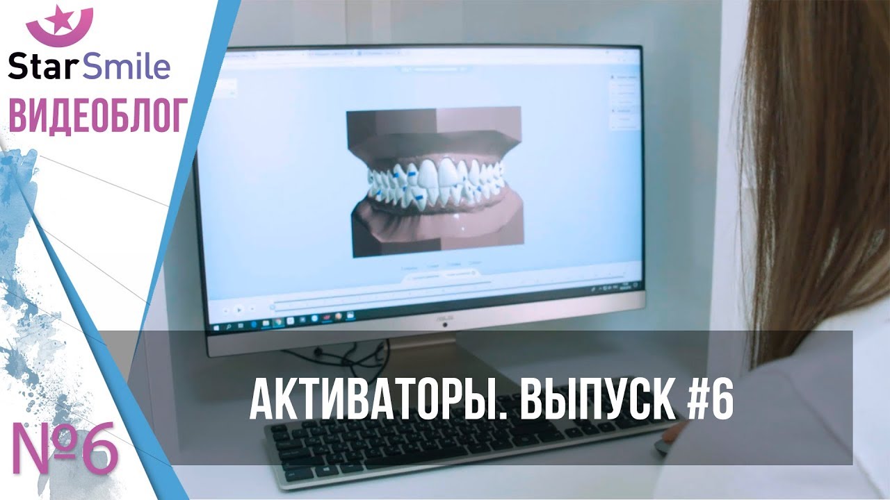 Ежик во рту?! Зачем устанавливают активаторы при лечении прикуса на элайнерах?