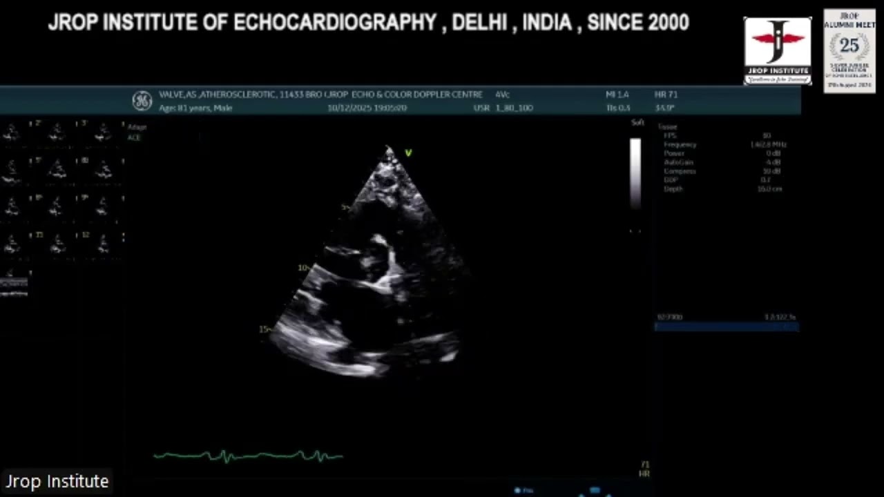 52nd 11th Session-Live Demonstration, Valvular Lesions ,11-12-2025