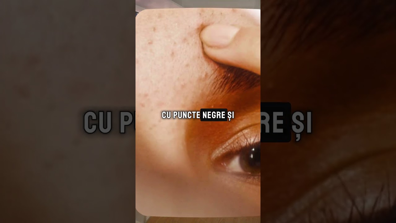 Duac gel sau Epiduo gel?
