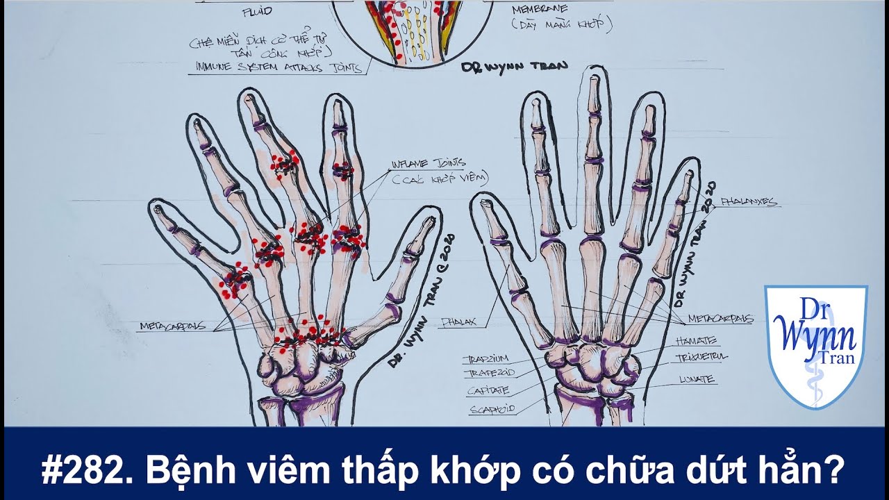 № 282. Можно ли вылечить ревматоидный артрит? Диагностика и лечение.