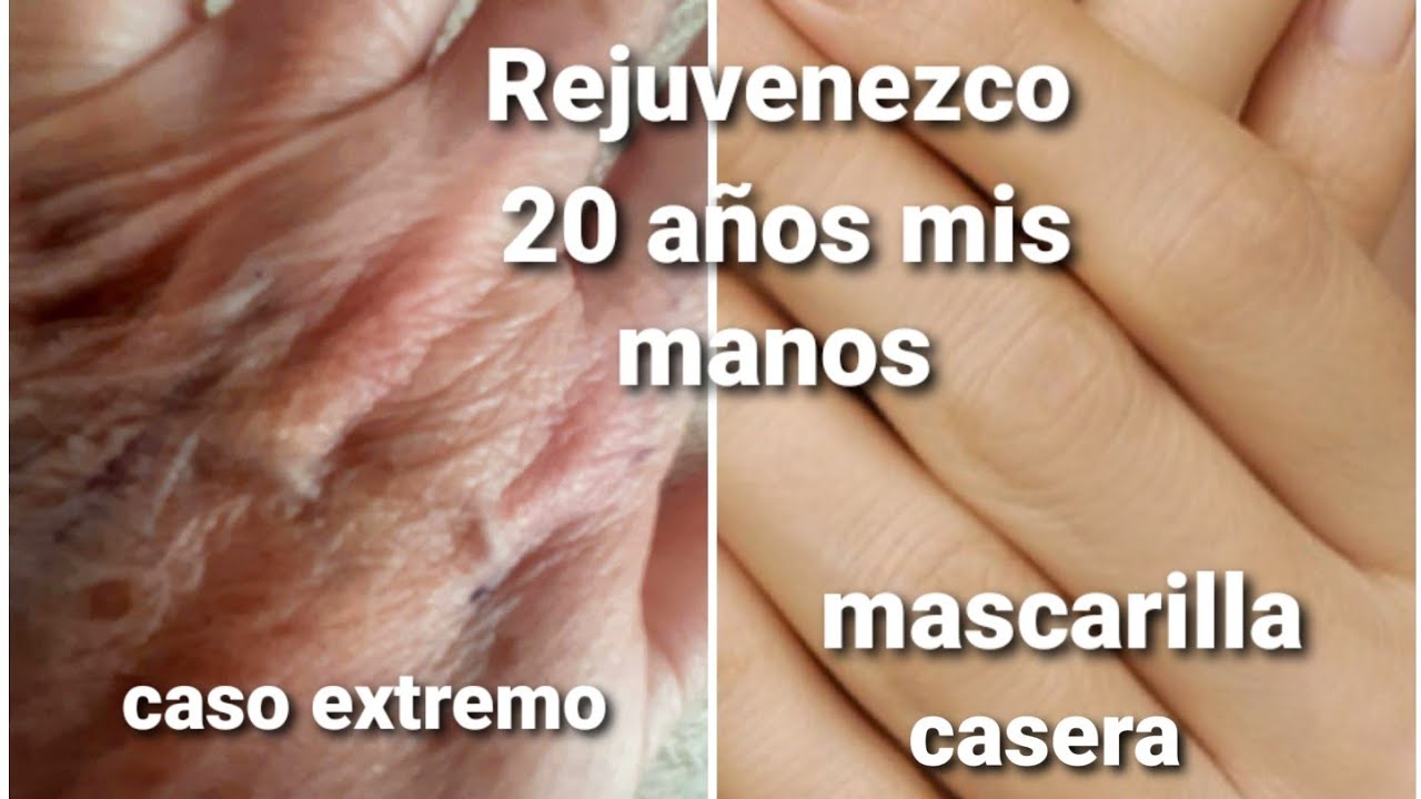 REJUVENEZCO 20 AÑOS MIS MANOS. CASO EXTREMO. MASCARILLA CASERA.