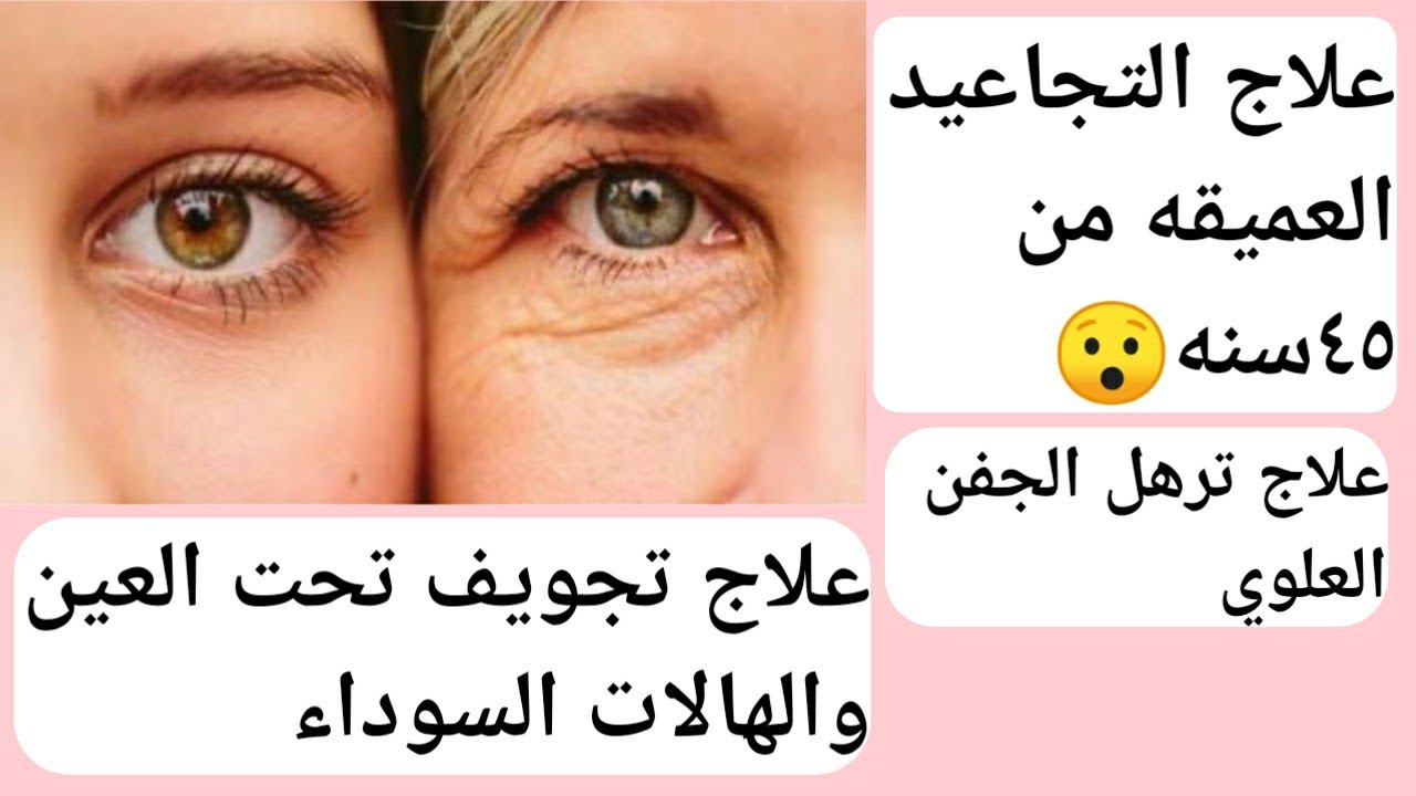 بديل الفيلر👍علاج التجاعيد العميقه والخطوط التعبيريه من سن ال٣٥ و٤٥ سنه+علاج للهالات السوداء